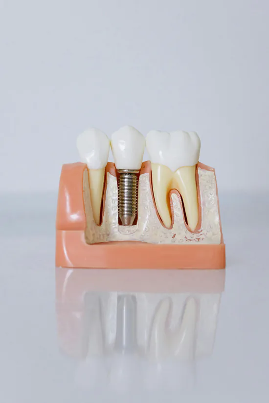 unique-smile-implantes-dentários-03